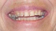 Before porcelain crowns
