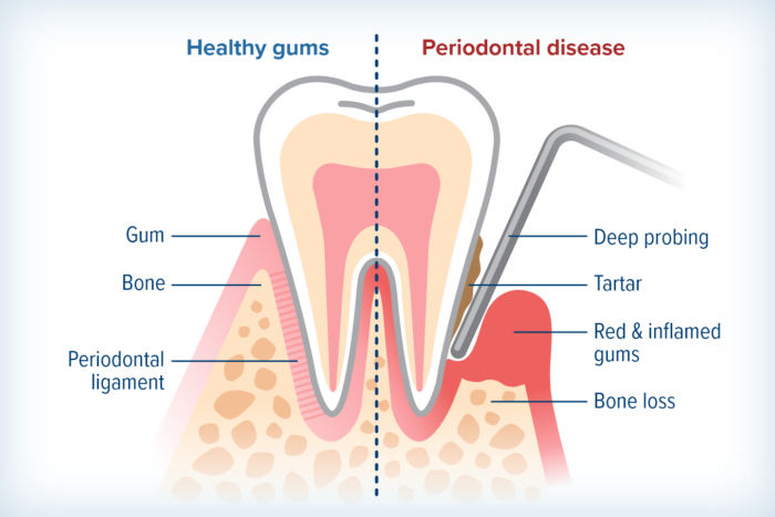 Diagram comparing healthy gums with periodontal disease, tartar, inflamed gums, and bone loss