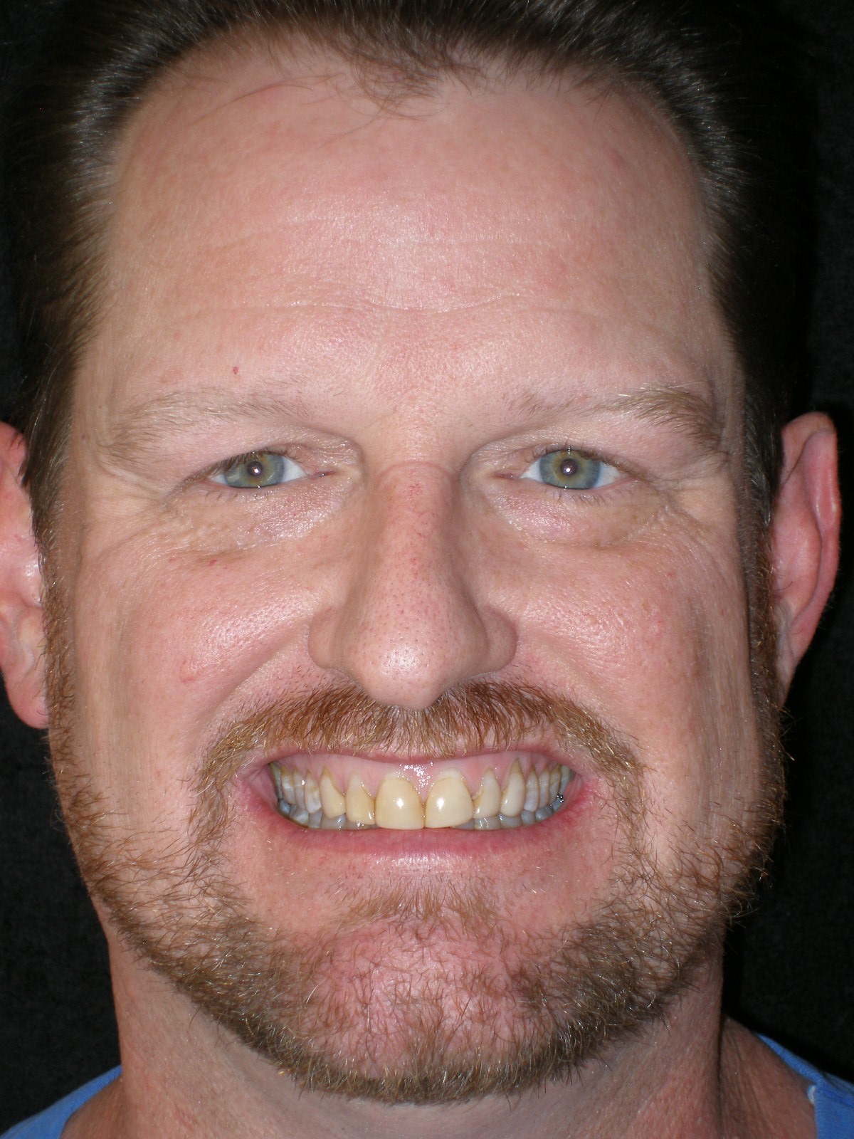 Before composite veneers, case 24