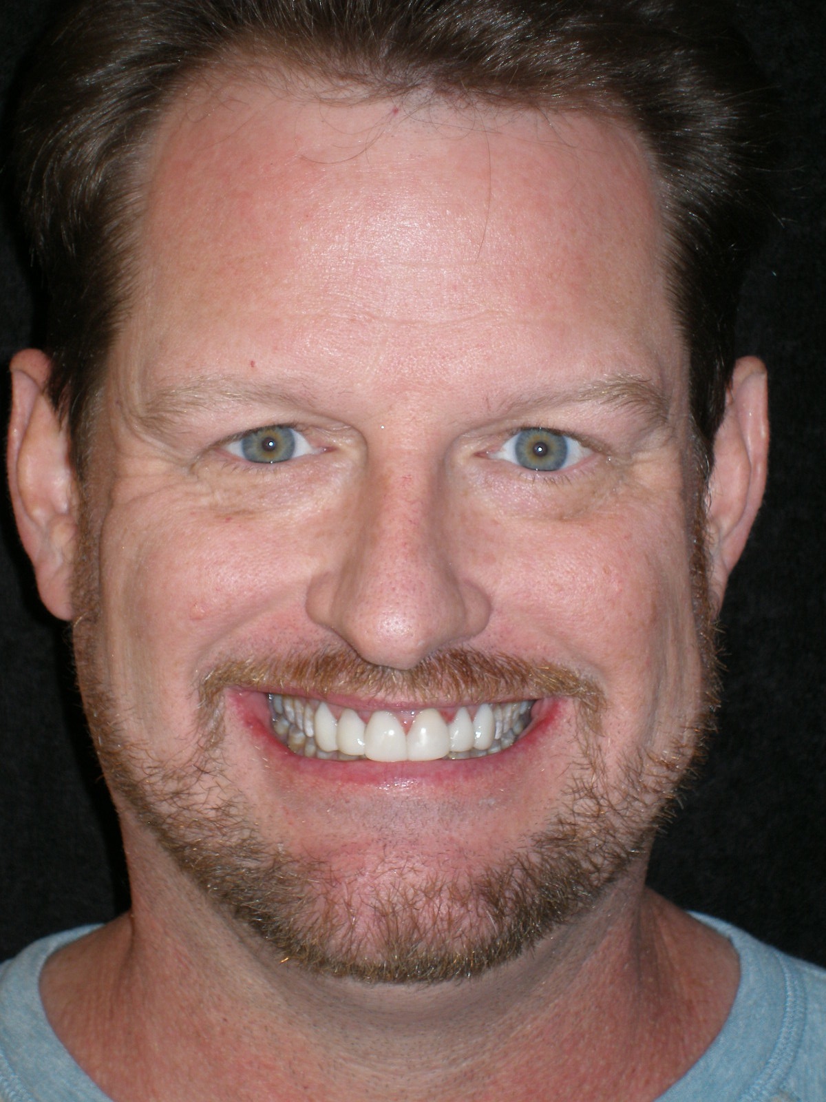 After composite veneers, case 24