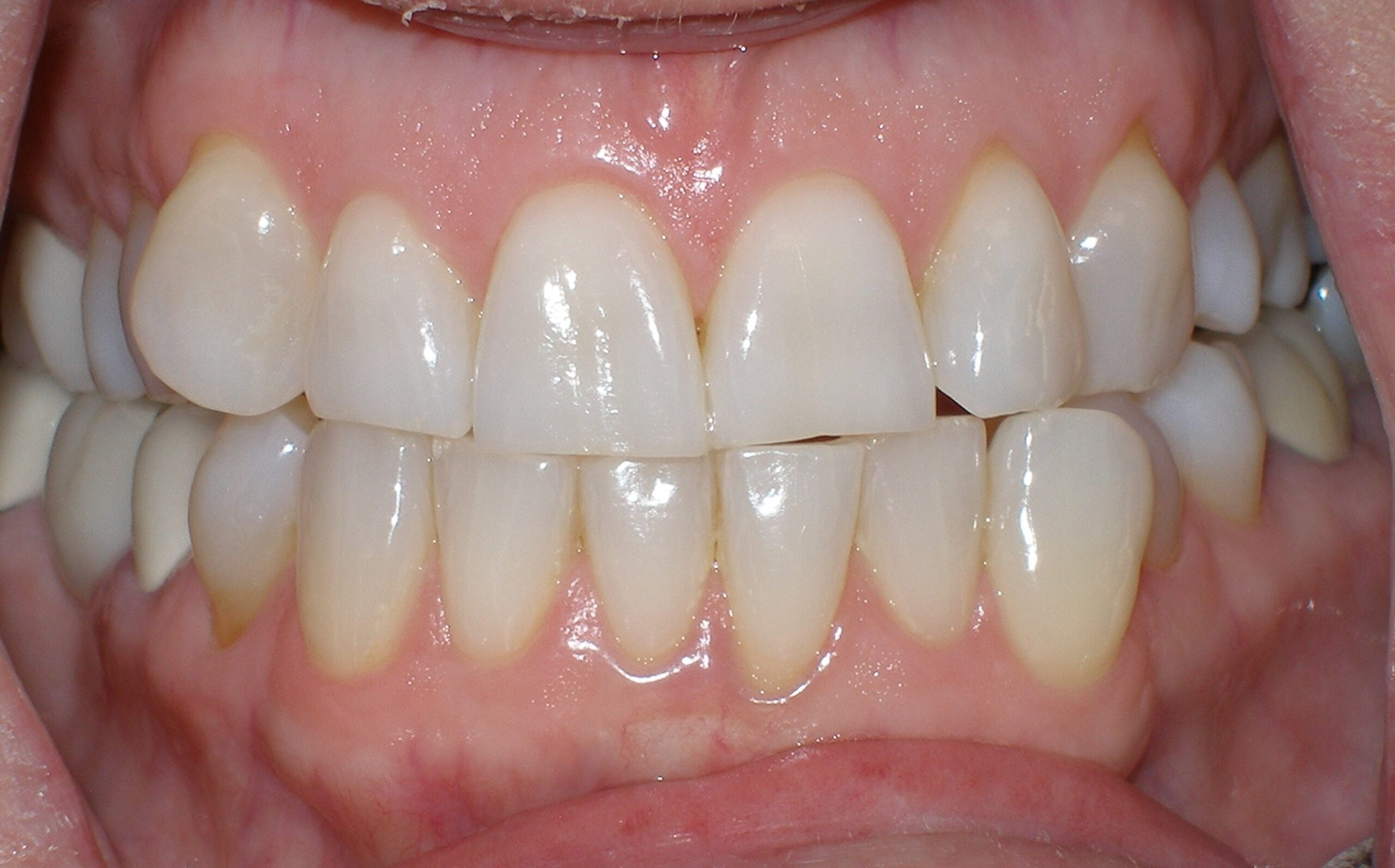 Teeth before Zoom whitening