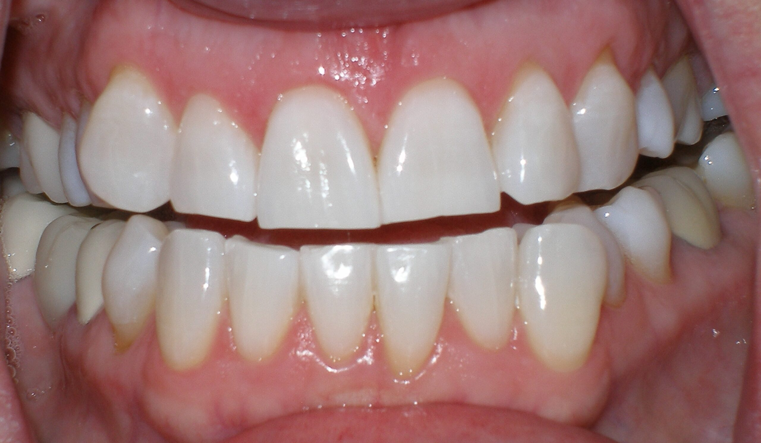 Teeth after Zoom whitening