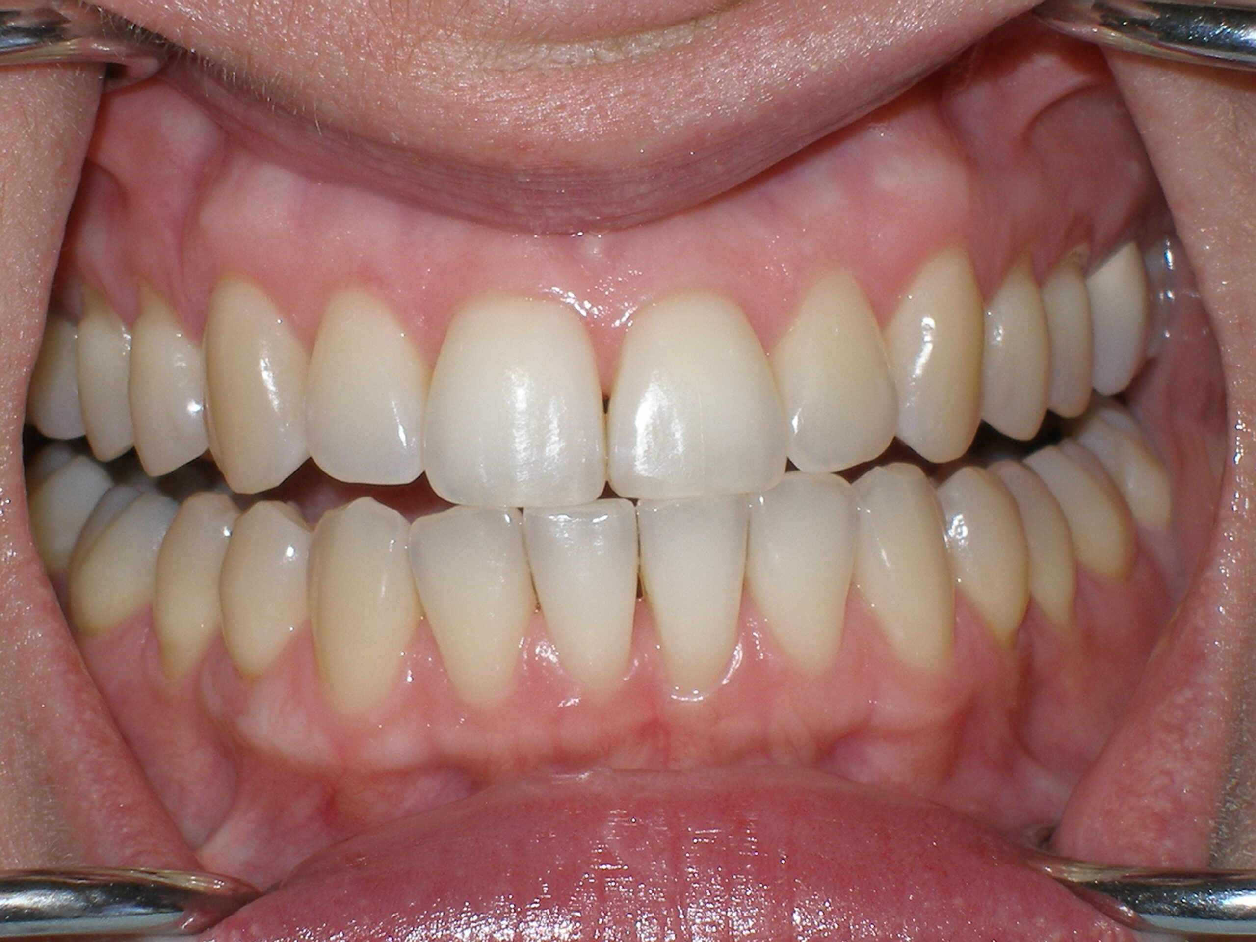 Teeth before Zoom whitening