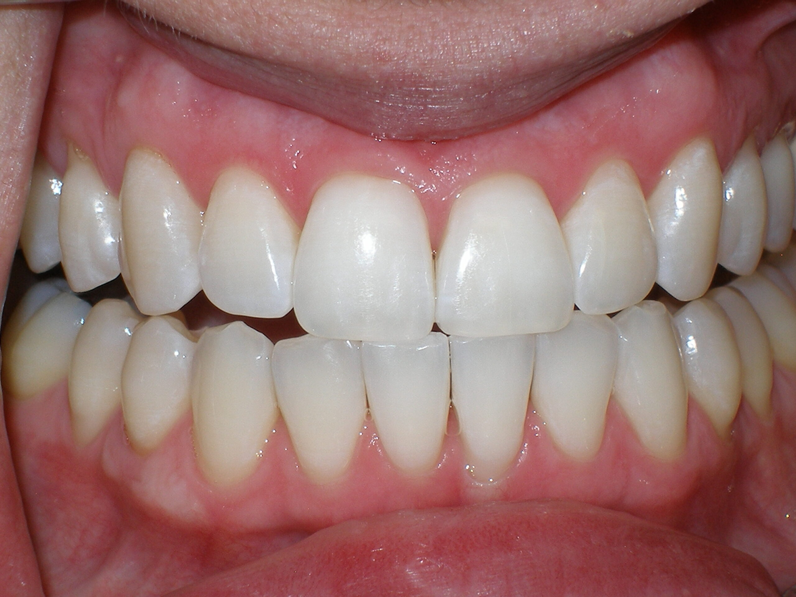 Teeth after Zoom whitening