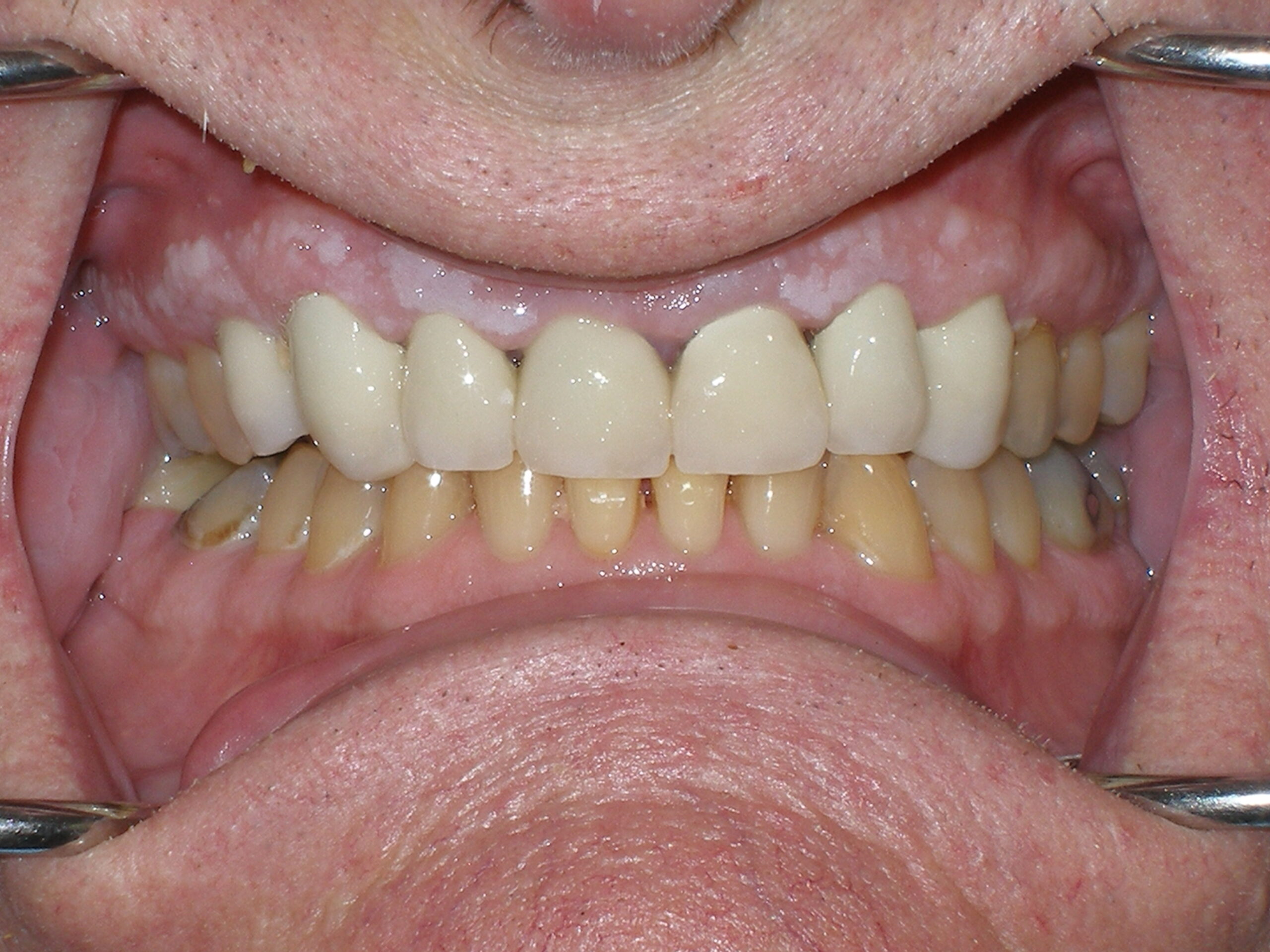 After all-porcelain crowns and bonding, case 30